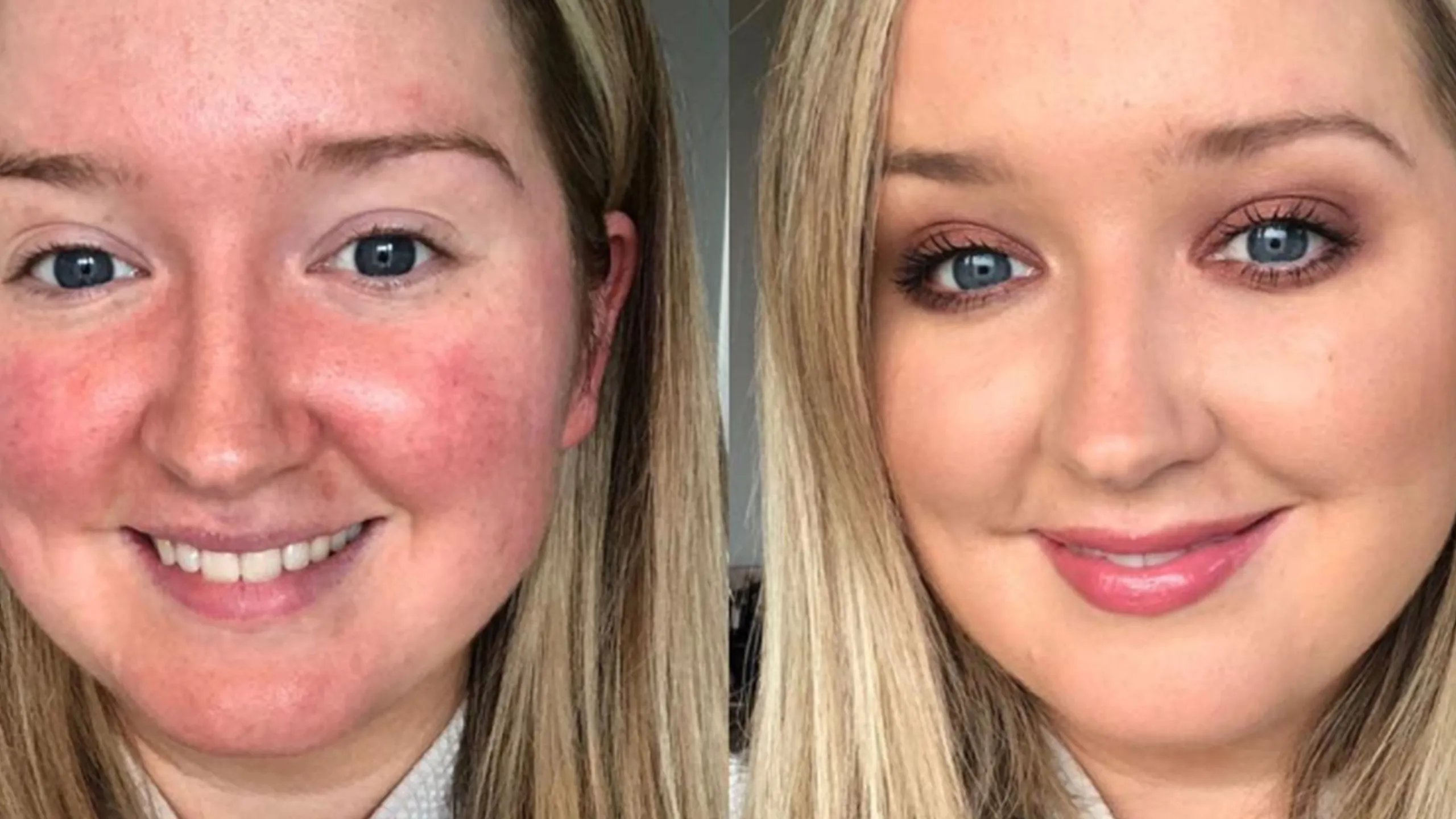 A Game Changer for Acne and Rosacea Treatment
